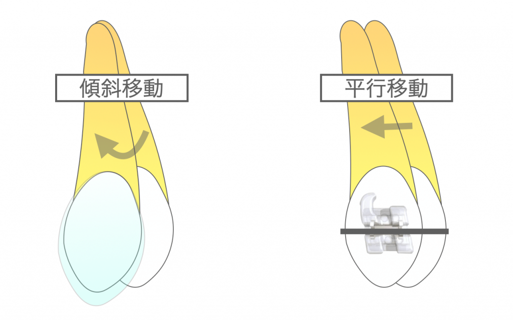 アライナー型矯正装置の治療指針の解釈【1】 - 東京のマウスピース型 